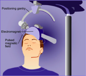 How transcranial magnetic stimulation is performed on a patient. Image from National Institute of Mental Health.
