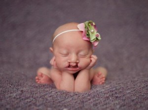 A photo of a newborn baby who has a cleft lip. [Source] 