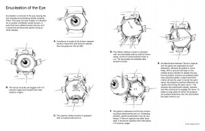 2011-08_Enucleation_Illustrator.jpg.pagespeed.ce.ZGJ8l0Wt0o