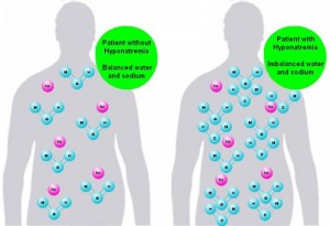 Hyponatremia-s-700x479