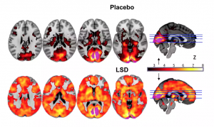 This image shows different sections of the brain, the top row on placebo and the bottom row under the influence of LSD. The orange and red areas indicate a greater amount of neural activity in the LSD group. Photograph: Imperial/Beckley Foundation